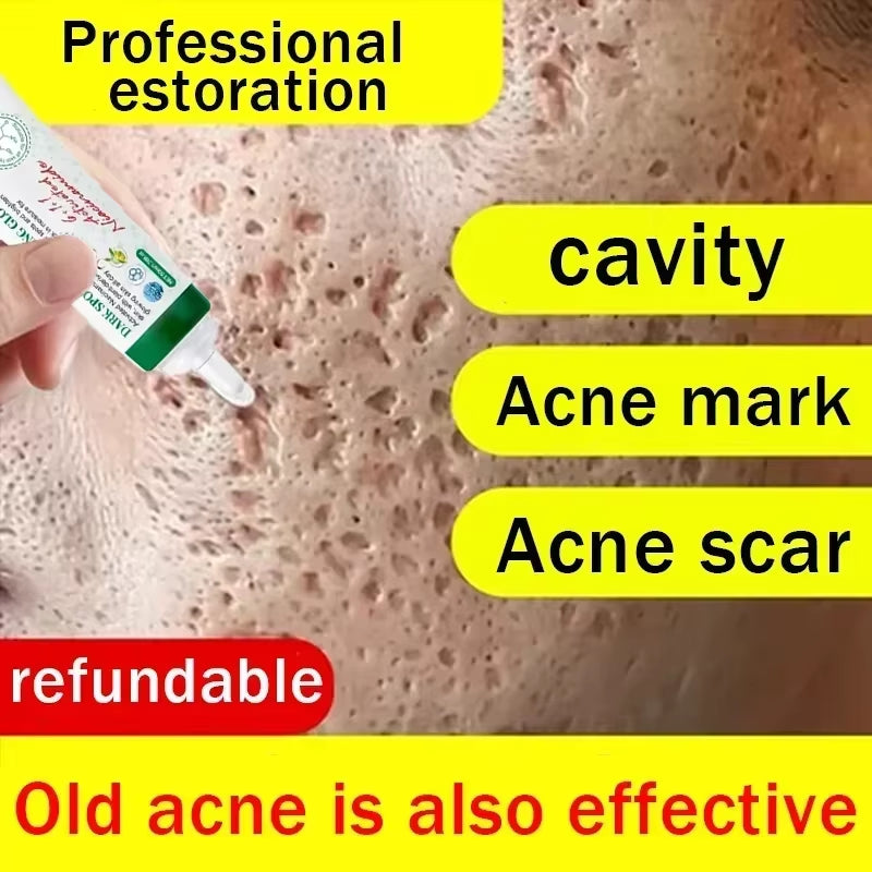 Anti-Acne Mark Pothole Repair Men'S Hole Repair Cream Fade to Remove Acne Mark Scar Fade Fill Regeneration Gel